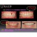 Gingivitis Treatment - Periodontal Disease Treatment-2