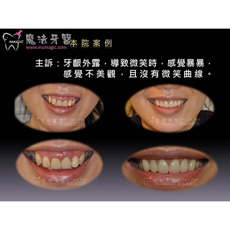 Full Mouth Dental Implants - Full Mouth Reconstruction-5