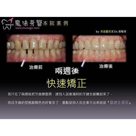 Teeth Whitening Treatment - Dental Esthetics-1