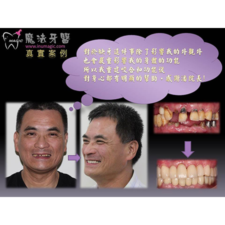 Full Mouth Restoration - Full Mouth Reconstruction-1