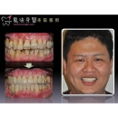 Periodontal Diseases Treatment - Periodontal Disease Treatment-6