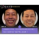 Anti Aging Dentistry - Dental Laser-1