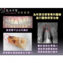 Root Canal Recovery - Dental Endodontic-4