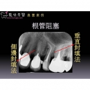 Root Canal Surgery - Dental Endodontic-2