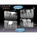 Root Canal Therapy - Dental Endodontic-3
