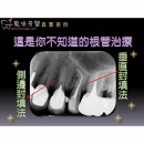 Root Canal Treatments - Dental Endodontic-5