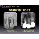 Apical Surgery - Dental Endodontic-7