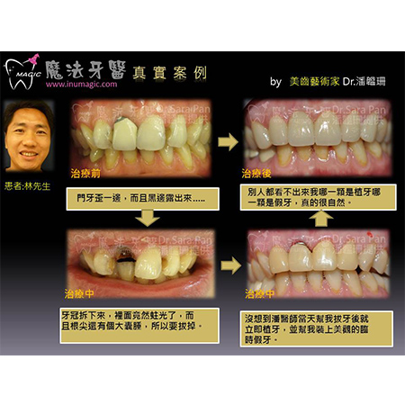 Dental Implants Front Teeth - Dental Implants-12
