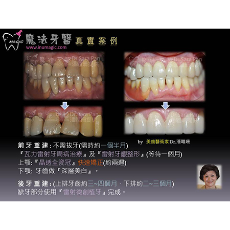 Dental Benefits - Dental Implants-17