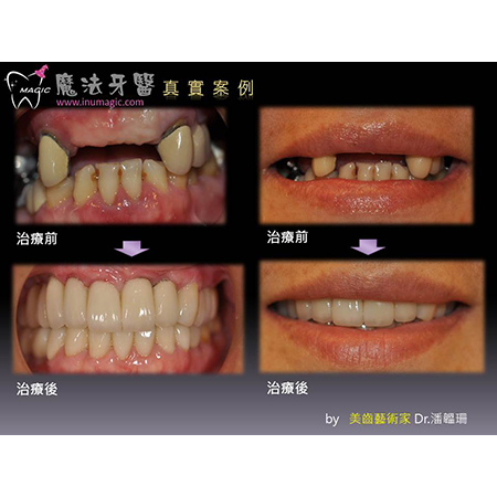 Missing Teeth - Dental Implants-21