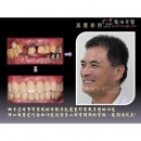 Best Dental Implants - Dental Implants-4