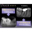 Calcified Root Canal - Dental Endodontic-1
