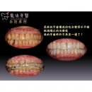 Invisible Teeth Straightening - Dental Orthodontic-10