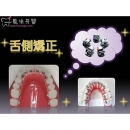 Lingual Braces - Dental Orthodontic-5