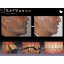 Painless Dental Implants - Dental Implants-13
