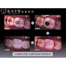 Ceramic Inlays - Dental Prosthodontics-4