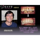 Dental Laser Surgery - Dental Laser-5