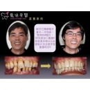 Dental Laser Treatment - Dental Laser-2