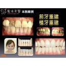 Laser Tooth Whitening - Dental Esthetics-11