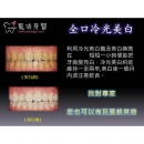 Professional Teeth Whitening - Dental Esthetics-14