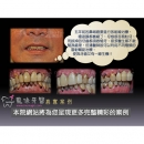 Dental Implant Surgery - Dental Implants-1