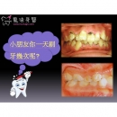 Dental Malocclusion - Children Dental-2