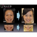 Full Mouth Reconstruction Implants - Full Mouth Reconstruction-7