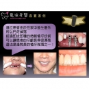Immediate Dental Implants - Dental Implants-18