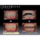 Teeth Crowding - Dental Esthetics-5