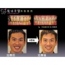 Gingival Flap Surgery - Full Mouth Reconstruction-4