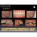 Dental Implant Recovery - Dental Implants-10