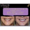 Ceramic Veneer - Dental Esthetics-15