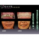 Laser Dental - Dental Laser-6