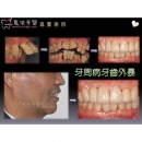 New Dental Implants - Dental Implants-9