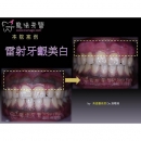 Gum Bleaching - Dental Esthetics-3