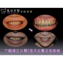 Teeth Correction - Dental Orthodontic-2