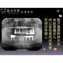 Pain Free Dental - Dental Implants-14