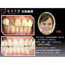 Teeth Whitening Laser - Dental Esthetics-4