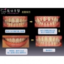 Temporary Dental Crown - Dental Prosthodontics-2