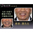 Full Mouth Rehabilitation - Full Mouth Reconstruction-2