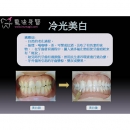Tooth Whitening Accelerator - Dental Esthetics-10
