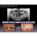 Surgical Dental Implant - Dental Implants-8