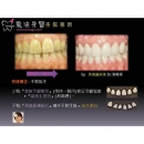 Best Tooth Whitening - Dental Esthetics-8