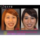 Gingival Surgery - Full Mouth Reconstruction-3
