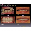 Missing Teeth - Dental Implants-21