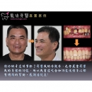 Ceramic Dental Implants - Dental Implants-20