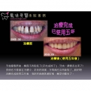 Laser Periodontal Treatment - Dental Laser-3