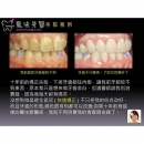 Home Teeth Whitening - Dental Esthetics-12
