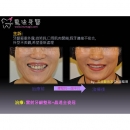 Full Mouth Implants - Full Mouth Reconstruction-6